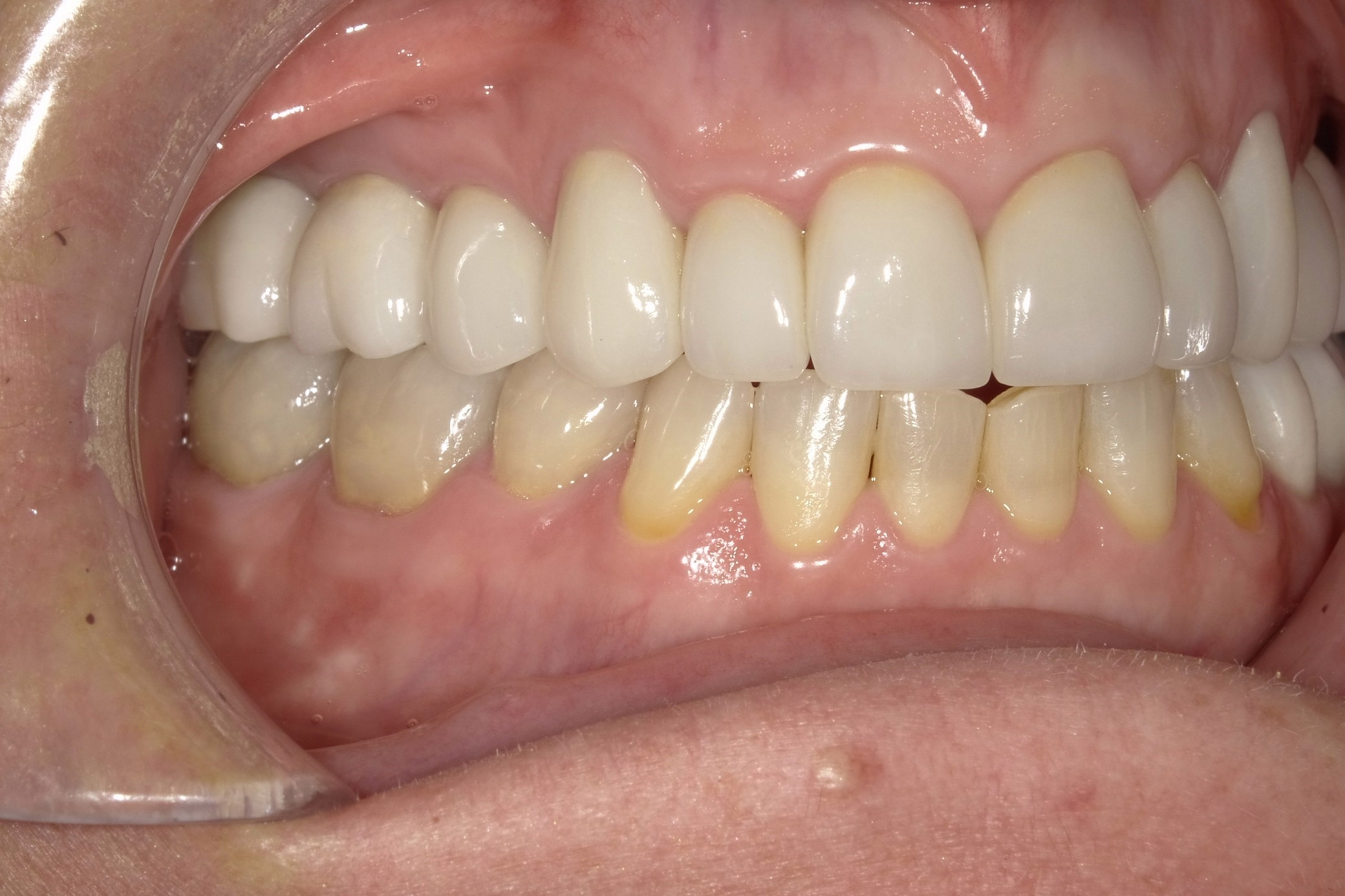 Crowns for Bite Correction